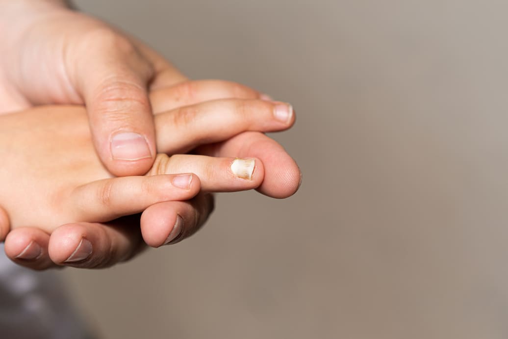 polamane-paznokcie-z-bialymi-plamami-u-seniora